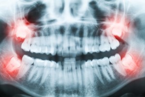 Closeup of x-ray image of teeth and mouth with all four molars vertically impacted and still not grown and visible in the jaw bone. Filled cavities visible. Impacted molars (wisdom teeth, teeth number 8) on the right side of the face (image left) shown red.